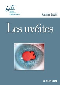 Les uvéites