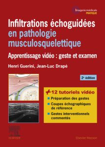 Infiltrations échoguidées en pathologie musculosquelettique