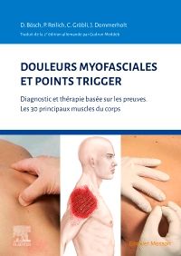 Douleurs myofasciales et points trigger