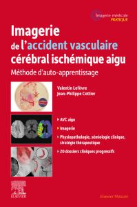 Imagerie de l'accident vasculaire cérébral ischémique aigu
