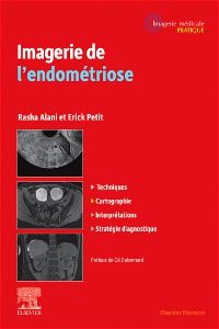 Imagerie de l'endométriose