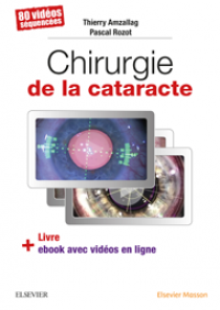 Chirurgie de la cataracte