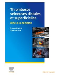 Thromboses veineuses distales et superficielles