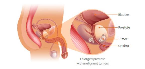 Prostate